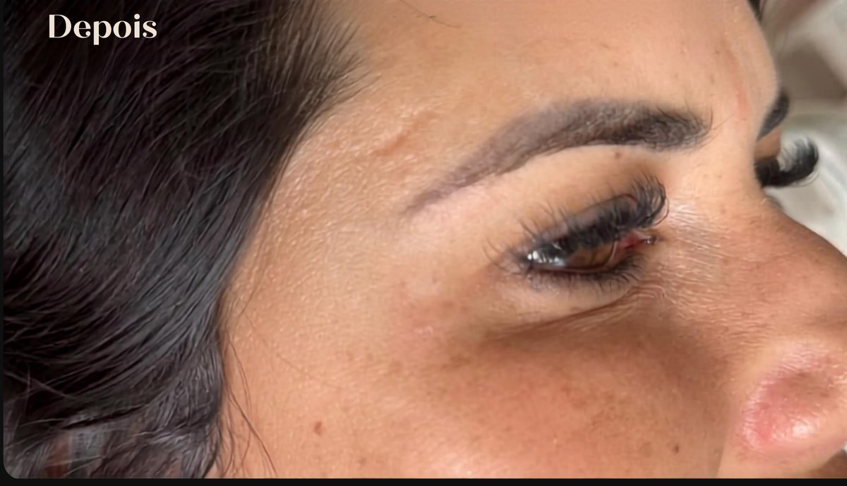 Detalhe do olhar de paciente após aplicação de toxina botulínica